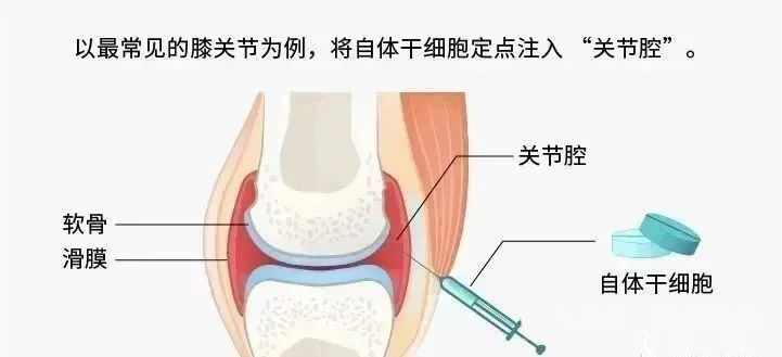 关节腔注射干细胞后,关节软骨持续再生!干细胞让骨关节炎康复成为可能 640 (2).jpg