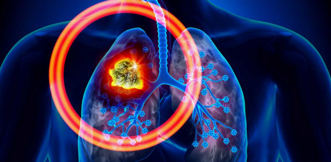 娃哈哈创始人宗庆后因肺癌逝世，专家呼吁重视免疫治疗在疾病防治中的作用