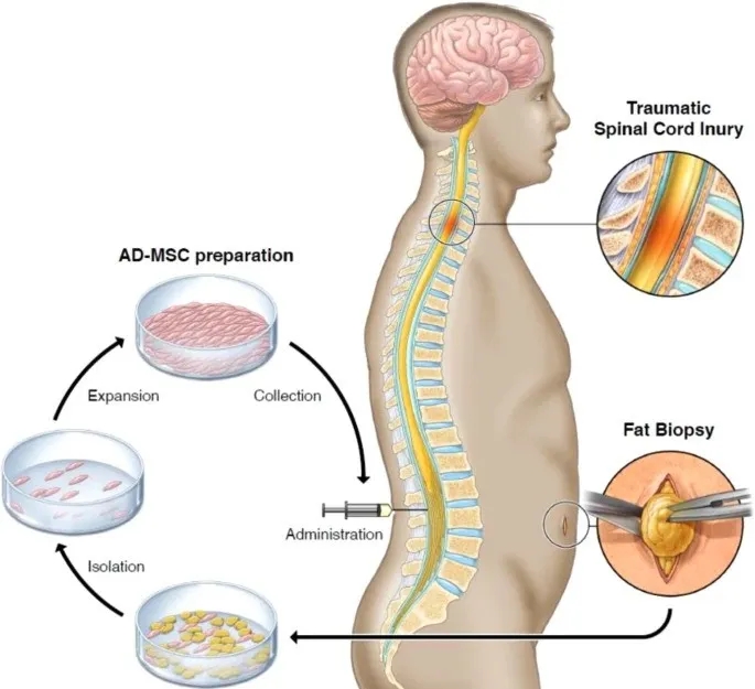 干细胞改善脊髓损伤的安全性和改善效果剖析