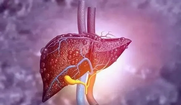 NK细胞改善肝病10例，生活质量明显提高
