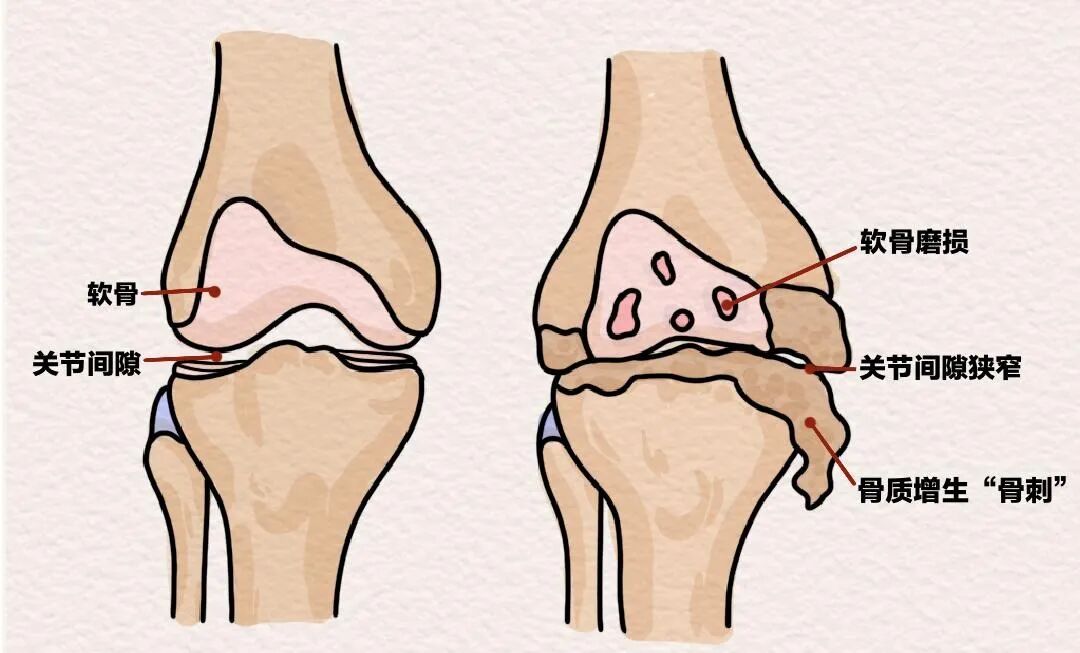 从“延缓磨损”到“促进再生”:干细胞如何干预骨关节炎?郑大干细胞库专家解读 1762134694274212.jpg