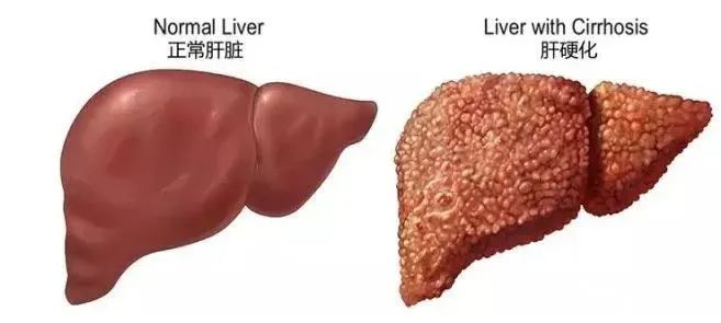 间充质干细胞改善肝硬化120例