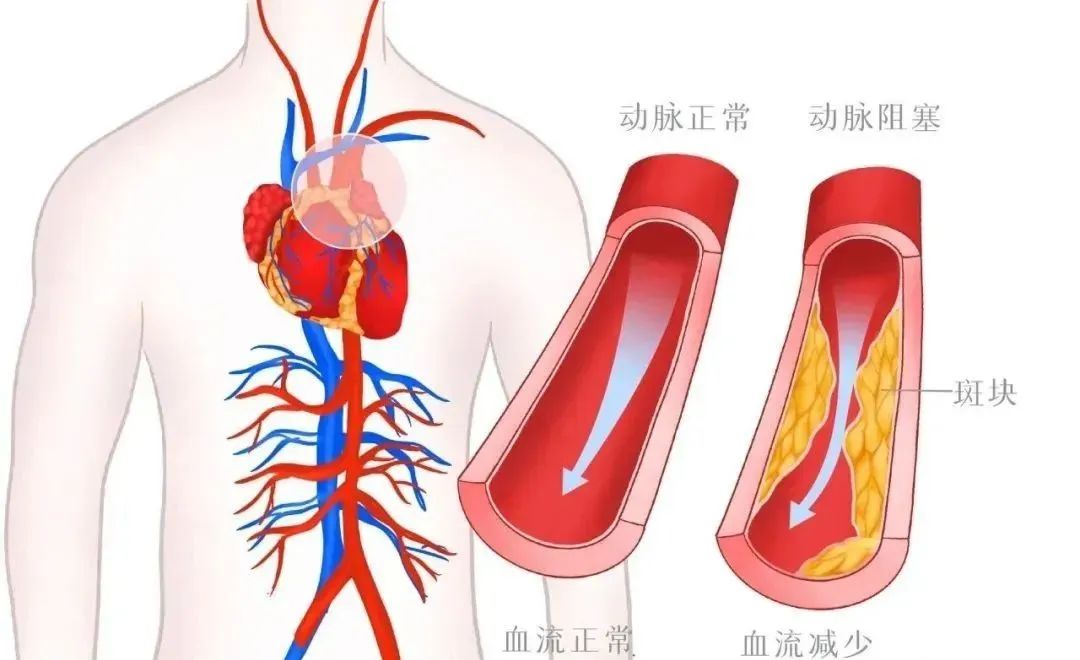 血管堵塞的六个信号，需引起重视！干细胞疗法让血管不再 “添堵”