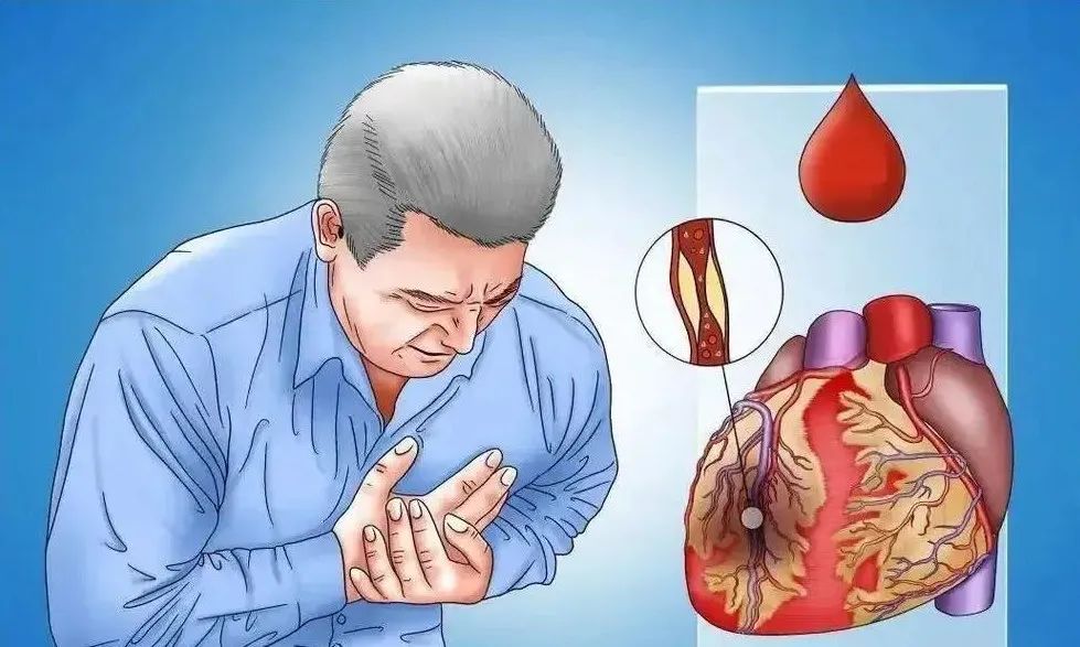 间充质干细胞干预心肌梗死，心功能显著改善