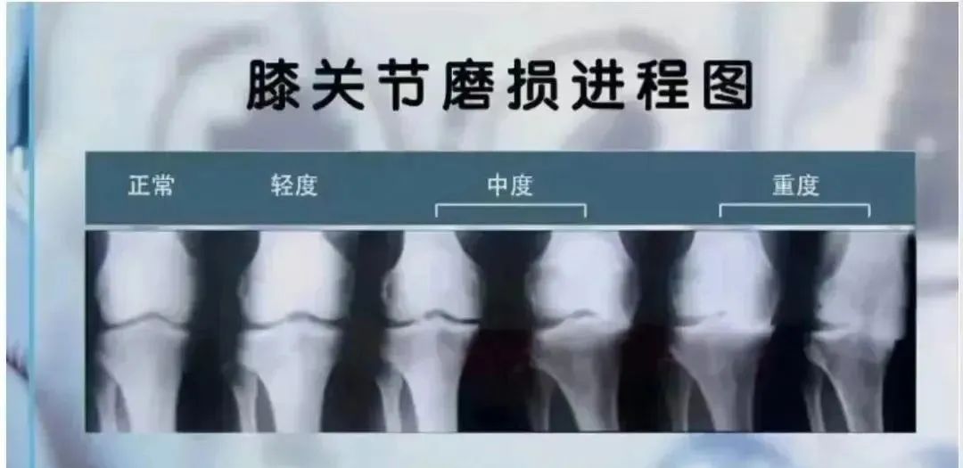 关节腔注射干细胞后，关节软骨持续再生！干细胞让骨关节炎康复成为可能