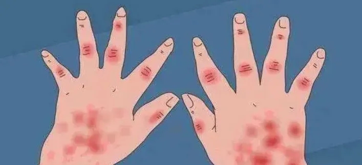 CAR-T细胞疗法又胜了！8例红斑狼疮患者，经治疗后都达到了临床缓解
