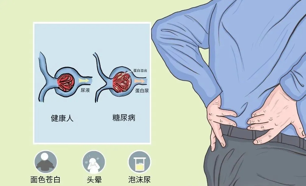 干细胞改善糖尿病肾病30例疗效显著