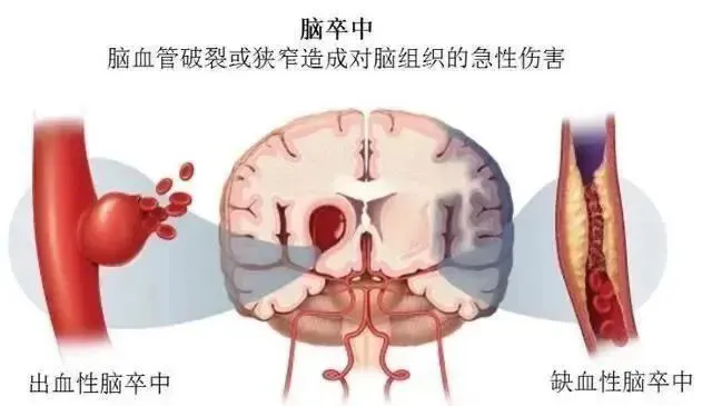 干细胞疗法可防止中风后进一步脑损伤